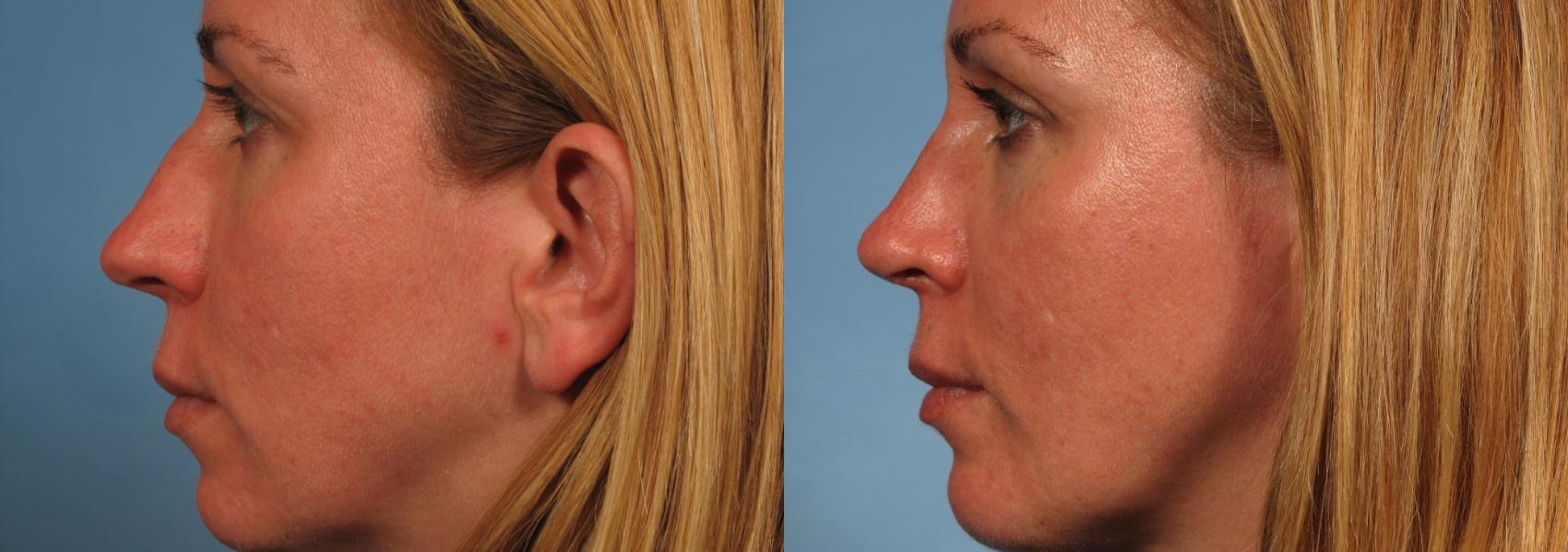 Before & After Rhinoplasty (Nose Reshaping) Case 140 View #1 View in Naples and Ft. Myers, FL