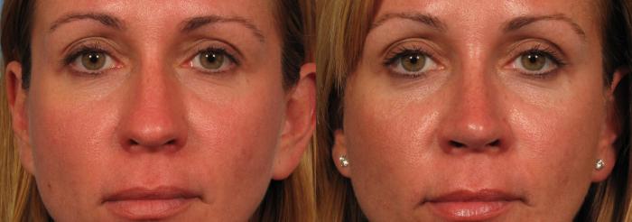 Before & After Rhinoplasty (Nose Reshaping) Case 140 View #2 View in Naples and Ft. Myers, FL