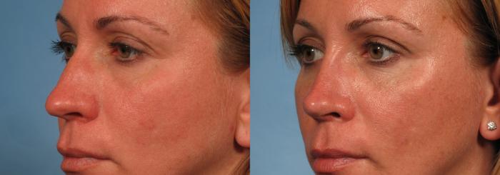 Before & After Rhinoplasty (Nose Reshaping) Case 140 View #3 View in Naples and Ft. Myers, FL