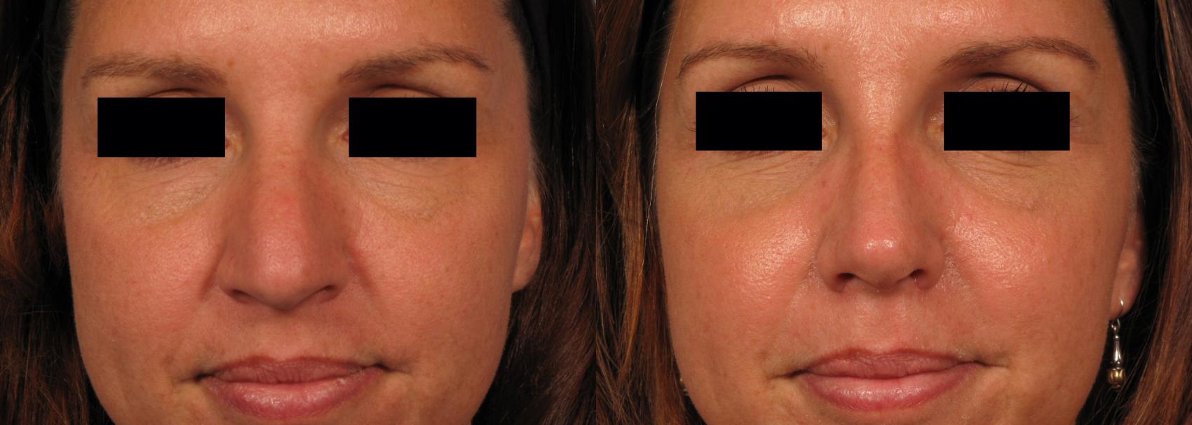 Before & After Rhinoplasty (Nose Reshaping) Case 141 View #1 View in Naples and Ft. Myers, FL