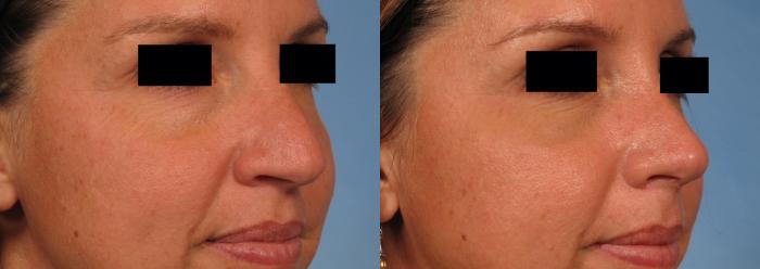 Before & After Rhinoplasty (Nose Reshaping) Case 141 View #2 View in Naples and Ft. Myers, FL
