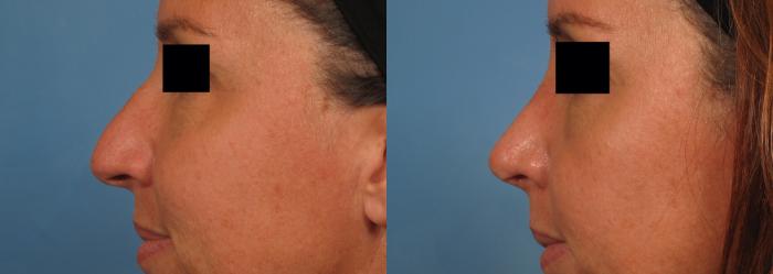 Before & After Rhinoplasty (Nose Reshaping) Case 141 View #3 View in Naples and Ft. Myers, FL