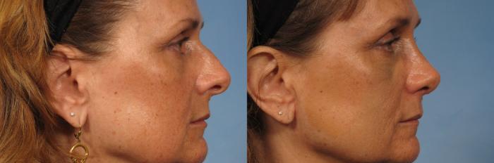 Before & After Rhinoplasty (Nose Reshaping) Case 145 View #1 View in Naples and Ft. Myers, FL