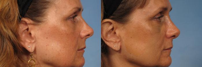 Before & After Rhinoplasty (Nose Reshaping) Case 145 View #2 View in Naples and Ft. Myers, FL