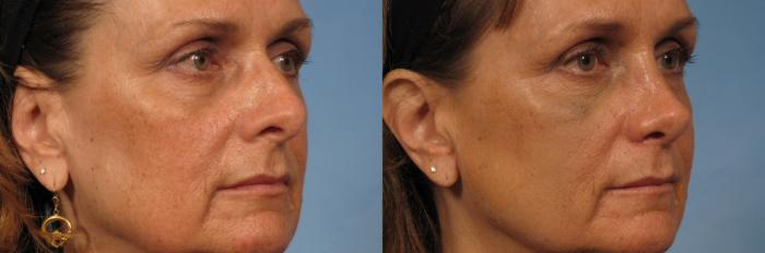 Before & After Rhinoplasty (Nose Reshaping) Case 145 View #3 View in Naples and Ft. Myers, FL