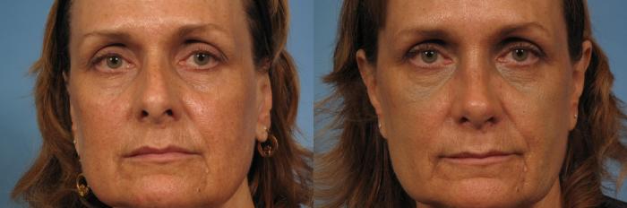Before & After Rhinoplasty (Nose Reshaping) Case 145 View #4 View in Naples and Ft. Myers, FL