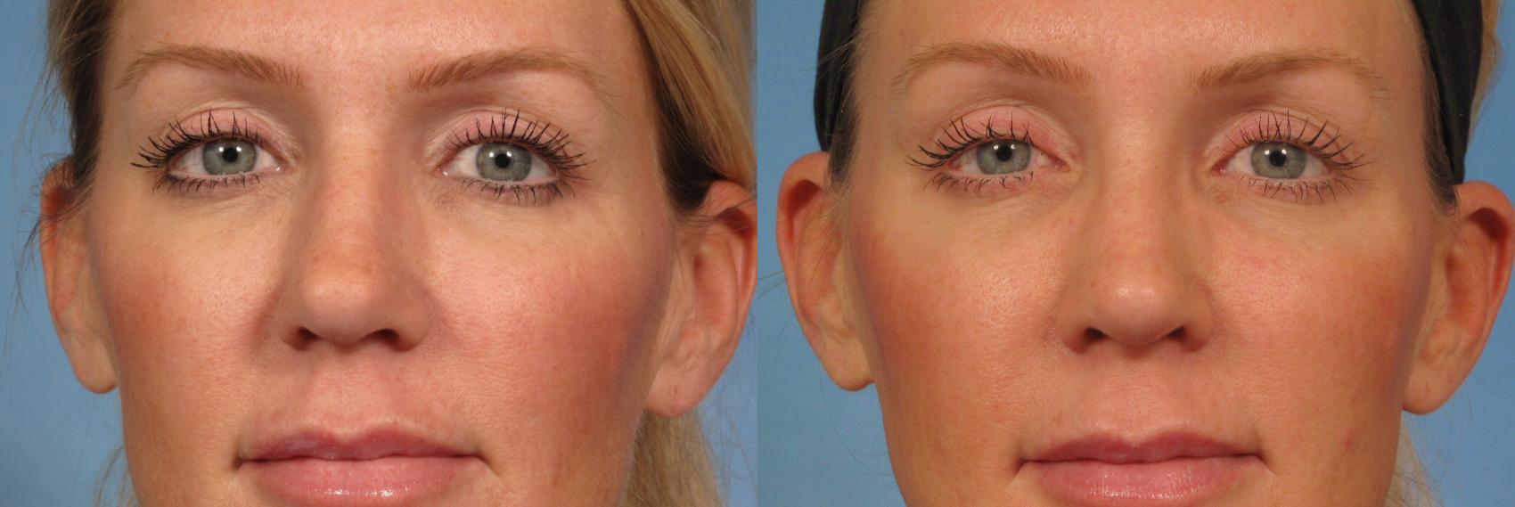 Before & After Rhinoplasty (Nose Reshaping) Case 152 View #1 View in Naples and Ft. Myers, FL