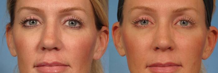 Before & After Rhinoplasty (Nose Reshaping) Case 152 View #1 View in Naples and Ft. Myers, FL