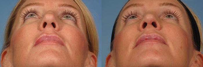 Before & After Rhinoplasty (Nose Reshaping) Case 152 View #2 View in Naples and Ft. Myers, FL