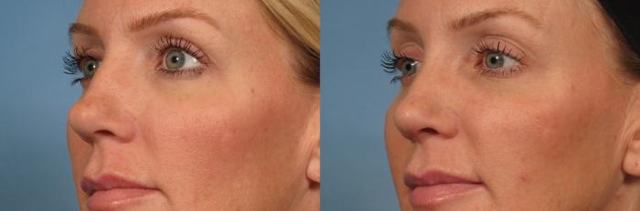 Before & After Rhinoplasty (Nose Reshaping) Case 152 View #3 View in Naples and Ft. Myers, FL