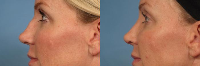 Before & After Rhinoplasty (Nose Reshaping) Case 152 View #4 View in Naples and Ft. Myers, FL
