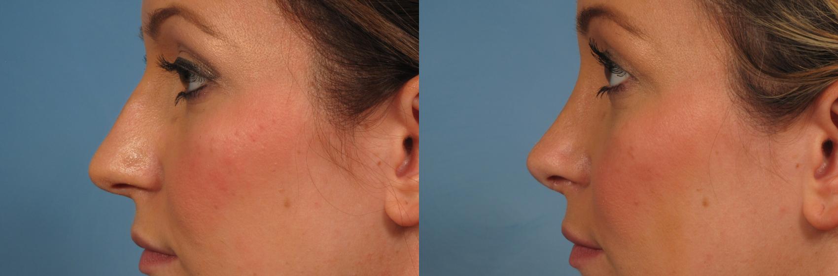Before & After Rhinoplasty (Nose Reshaping) Case 219 View #1 View in Naples and Ft. Myers, FL