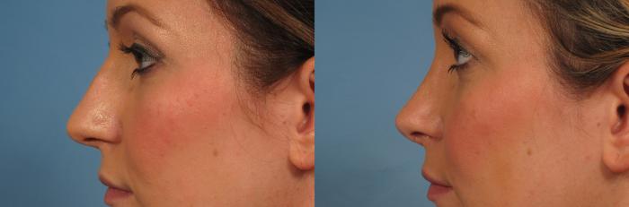 Before & After Rhinoplasty (Nose Reshaping) Case 219 View #1 View in Naples and Ft. Myers, FL