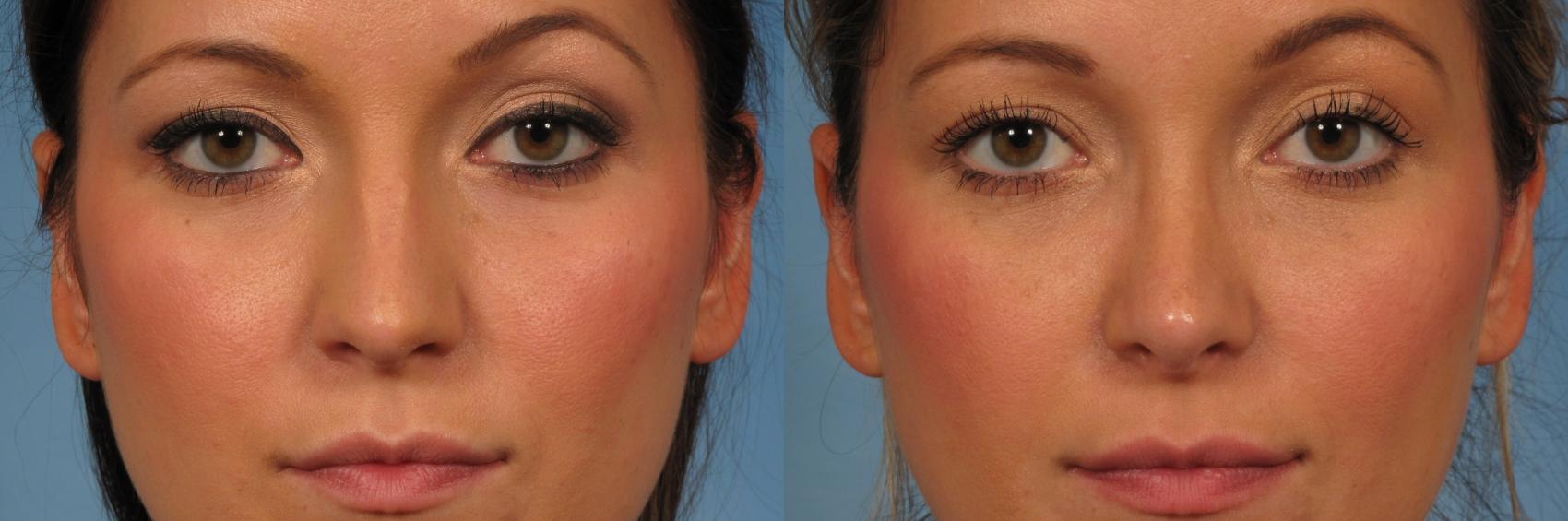 Rhinoplasty (Nose Reshaping) Before and After Pictures Case 219