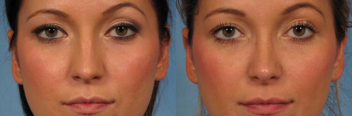 Before & After Rhinoplasty (Nose Reshaping) Case 219 View #3 View in Naples and Ft. Myers, FL