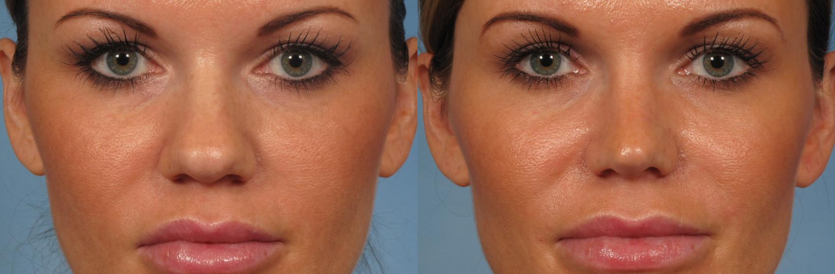 Before & After Rhinoplasty (Nose Reshaping) Case 221 View #1 View in Naples and Ft. Myers, FL