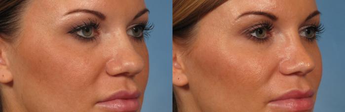 Before & After Rhinoplasty (Nose Reshaping) Case 221 View #3 View in Naples and Ft. Myers, FL