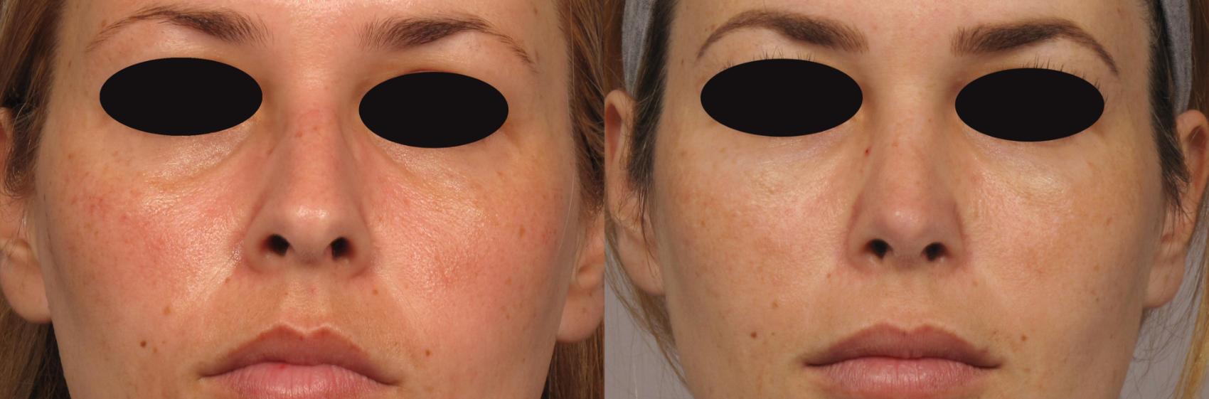 Pre-op Frontal view of Rhinoplasty (Nose Reshaping) by Dr. Kent Hasen