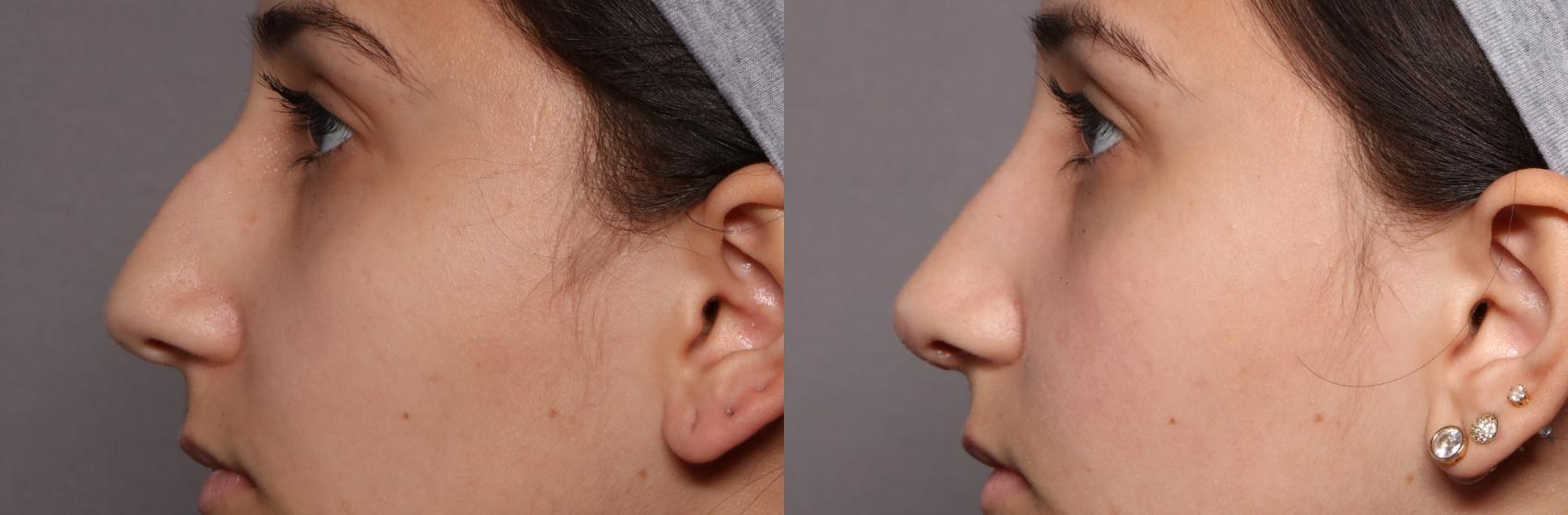 Pre-op Left Side View of Rhinoplasty Patient of Dr. Hasen in Naples Florida