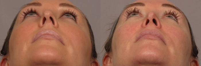 Pre-op Worm's Eye View of Rhinoplasty or Nose Reshaping by Dr. Hasen