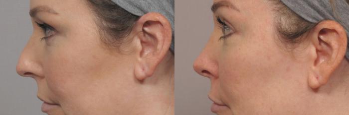 Pre-op Left Side View of Rhinoplasty or Nose Reshaping by Dr. Hasen