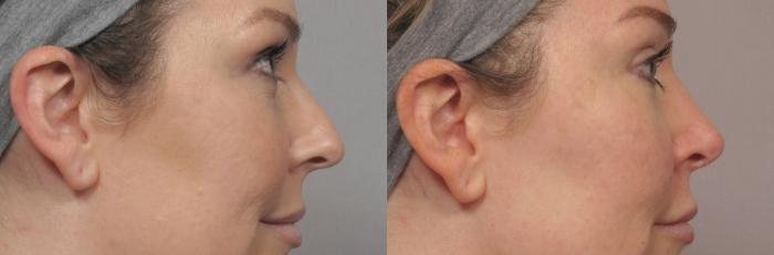 Pre-op Right Side View of Rhinoplasty (Nose Reshaping) in Naples, Florida by Kent V. Hasen, M.D.
