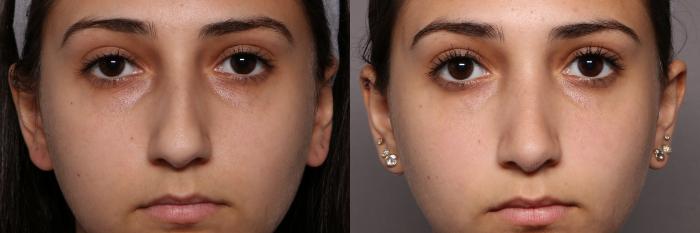 Rhinoplasty (Nose Reshaping) Before and After Photo, Front View, Pre