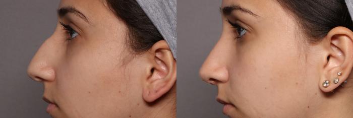 Rhinoplasty (Nose Reshaping) Before and After Photo, Left Side View, Pre