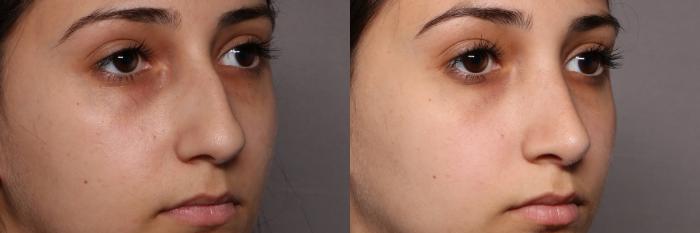 Rhinoplasty (Nose Reshaping) Before and After Photo, Right Oblique View, Pre