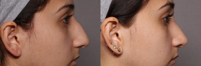 Rhinoplasty (Nose Reshaping) Before and After Photo, Right Side View, Pre