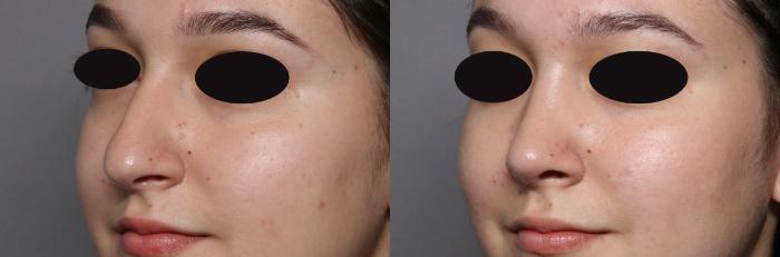Rhinoplasty Left Side View, Pre