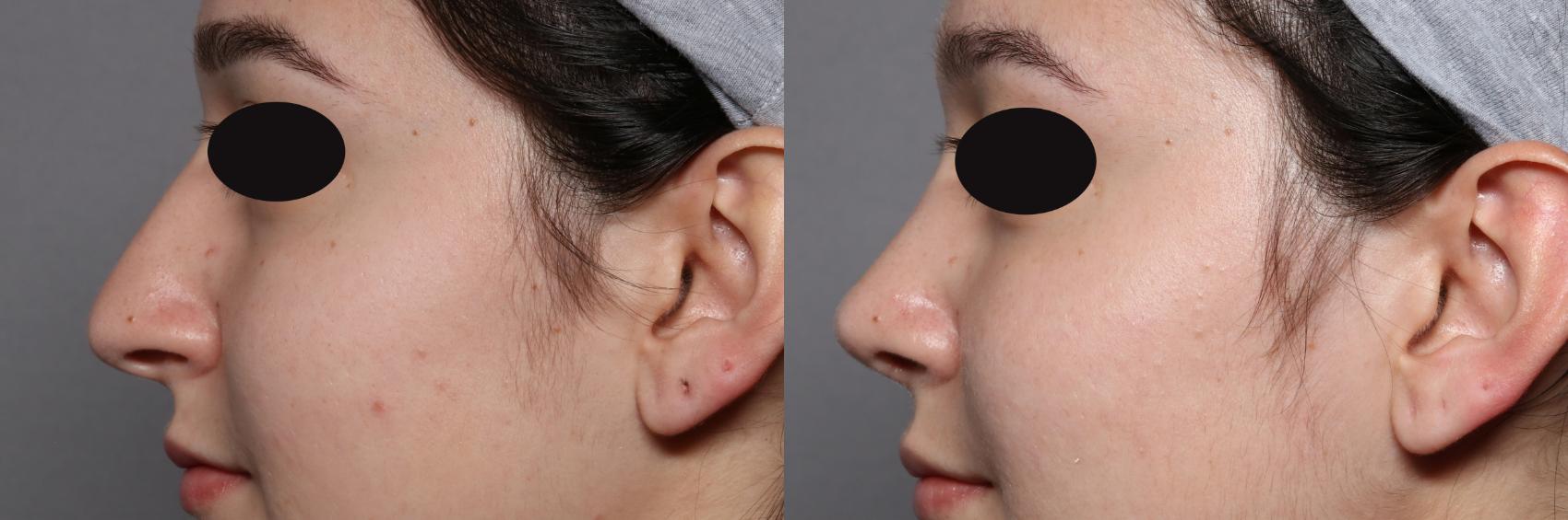 Rhinoplasty Left Side View, Pre