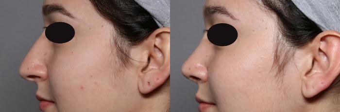 Rhinoplasty Left Side View, Pre