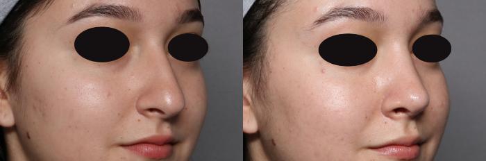 Rhinoplasty Right Oblique View, Pre