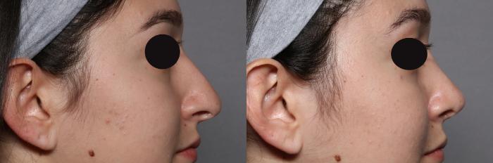 Rhinoplasty Right Side View, Pre