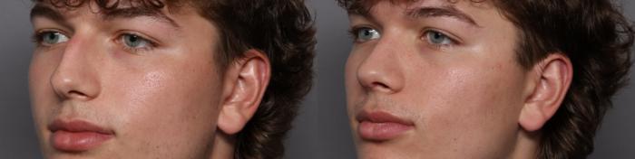 Rhinoplasty Left Oblique View Before
