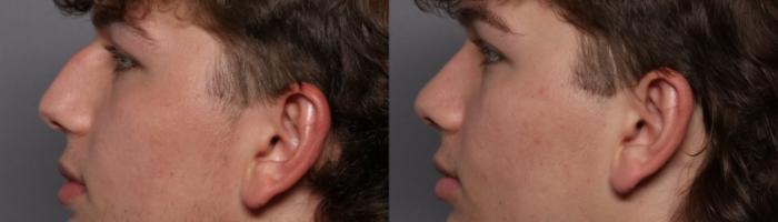 Rhinoplasty Left Side View Before