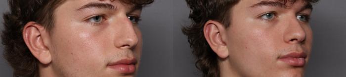 Rhinoplasty Right Oblique View Before