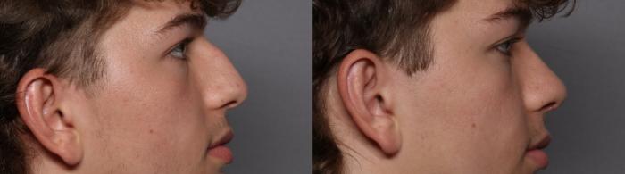 Rhinoplasty Right Side View Before