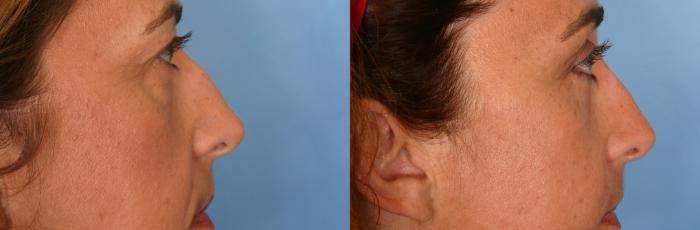 Before & After Rhinoplasty (Nose Reshaping) Case 62 View #1 View in Naples and Ft. Myers, FL