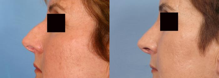 Before & After Rhinoplasty (Nose Reshaping) Case 78 View #3 View in Naples and Ft. Myers, FL