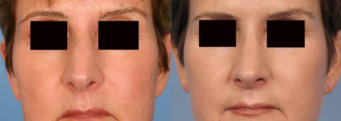 Before & After Rhinoplasty (Nose Reshaping) Case 78 View #4 View in Naples and Ft. Myers, FL
