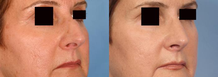 Before & After Rhinoplasty (Nose Reshaping) Case 78 View #5 View in Naples and Ft. Myers, FL