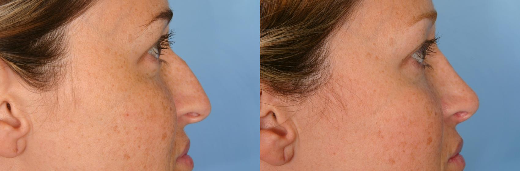 Before & After Rhinoplasty (Nose Reshaping) Case 79 View #1 View in Naples and Ft. Myers, FL
