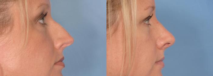 Before & After Rhinoplasty (Nose Reshaping) Case 87 View #1 View in Naples and Ft. Myers, FL