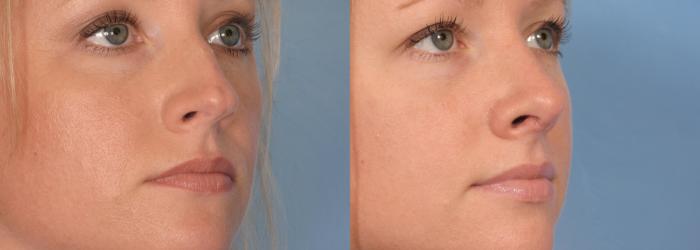 Before & After Rhinoplasty (Nose Reshaping) Case 87 View #3 View in Naples and Ft. Myers, FL