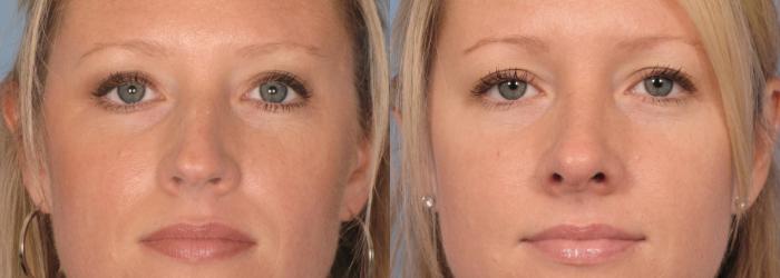 Before & After Rhinoplasty (Nose Reshaping) Case 87 View #4 View in Naples and Ft. Myers, FL