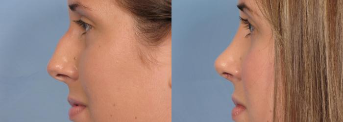 Before & After Rhinoplasty (Nose Reshaping) Case 91 View #1 View in Naples and Ft. Myers, FL