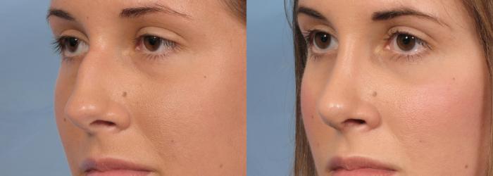 Before & After Rhinoplasty (Nose Reshaping) Case 91 View #2 View in Naples and Ft. Myers, FL