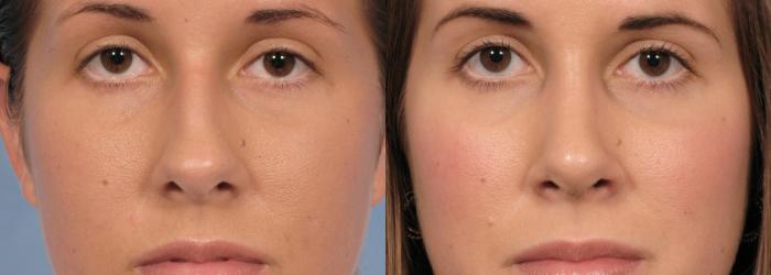 Before & After Rhinoplasty (Nose Reshaping) Case 91 View #3 View in Naples and Ft. Myers, FL